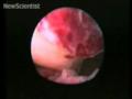 Human ovulation